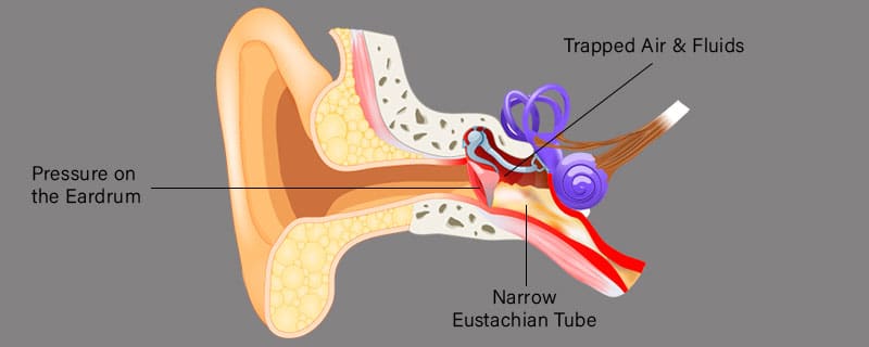 Types of Ear Barotrauma - La Galigo Liveaboard